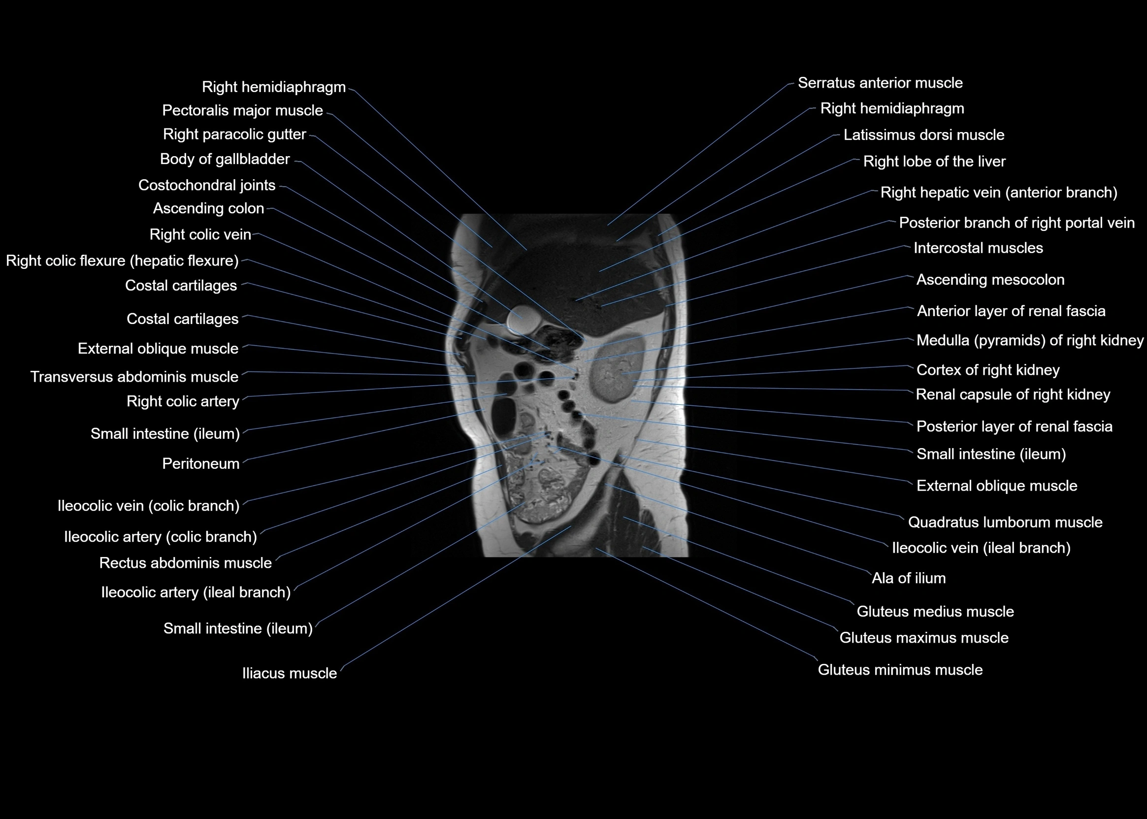 MRI abdomen sagittal cross sectional anatomy  radiology  image-img-00001-00019.webp